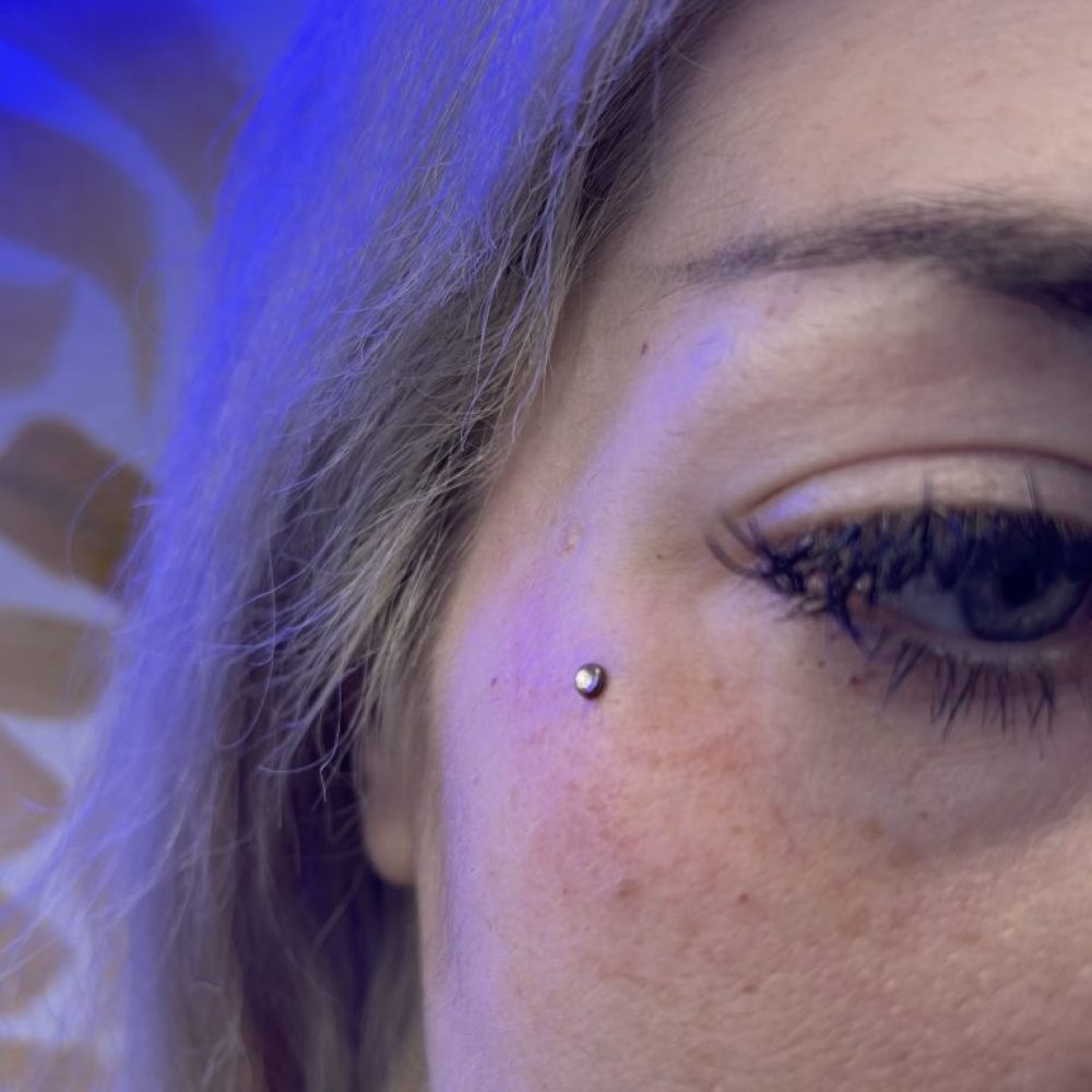 Dermal on female cheekbone