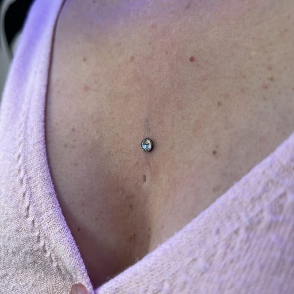Dermal on women's chest
