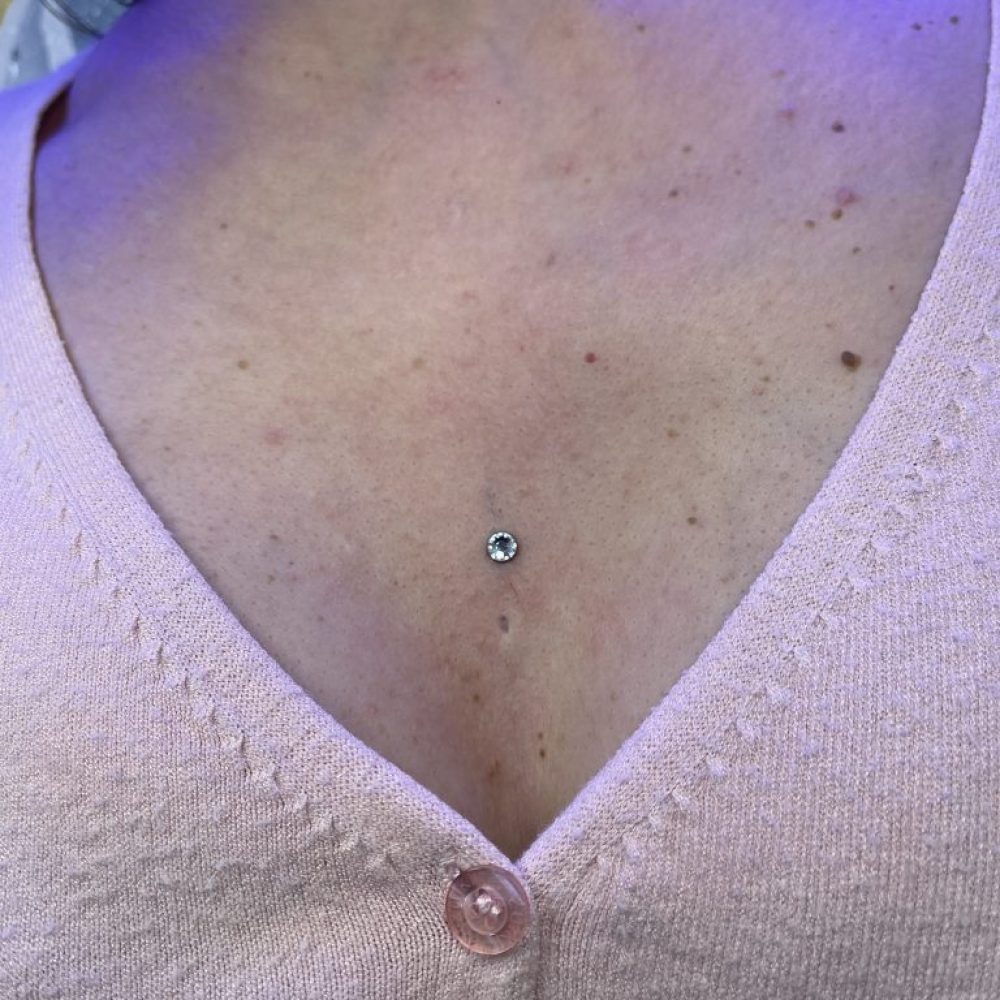 Dermal on women's chest